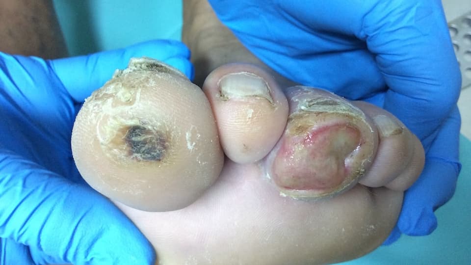 P Dávid cukorbeteg láb lökéshullám terápia