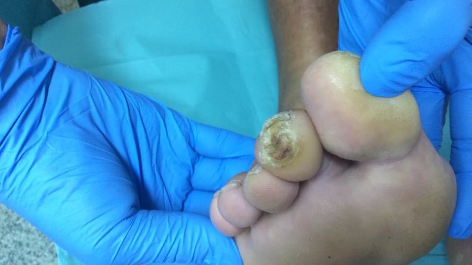 P Dávid cukorbeteg láb lökéshullám terápia