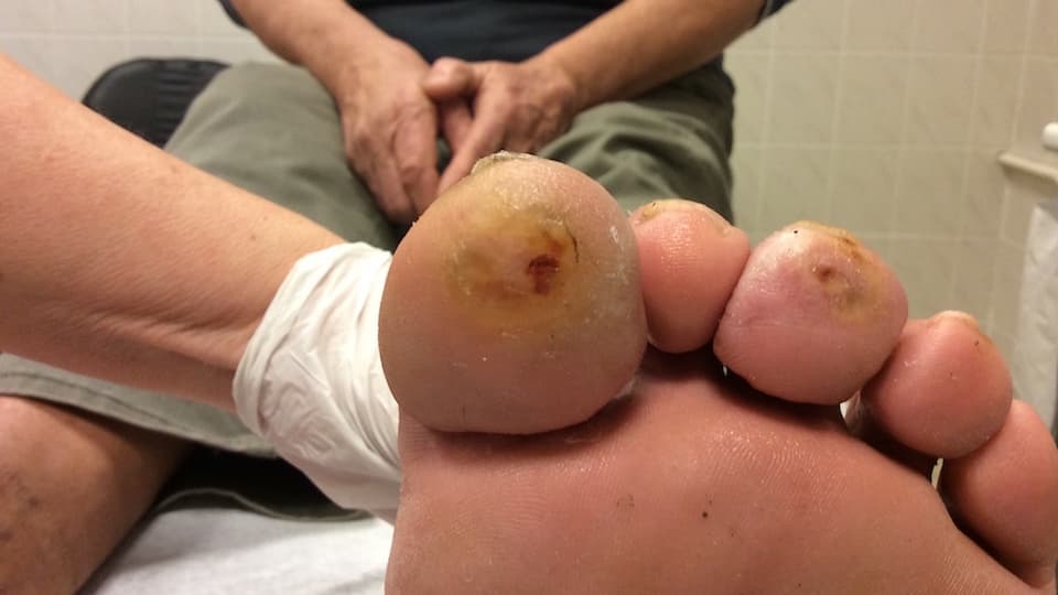 P Dávid cukorbeteg láb lökéshullám terápia