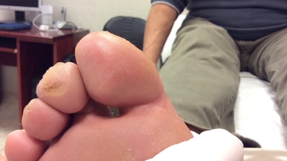 P Dávid cukorbeteg láb lökéshullám terápia