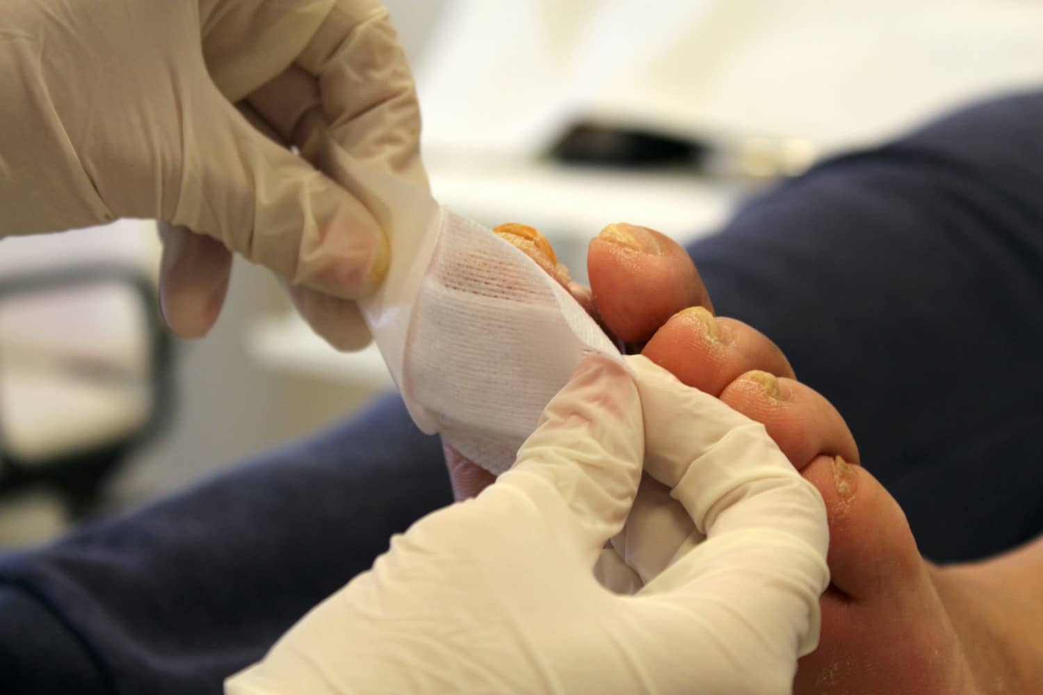 Cukorbeteg láb sebgyógyulás