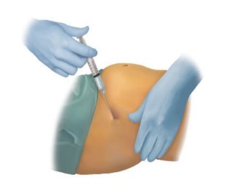 Hogyan zajlik a LIPOGEMS beavatkozás?