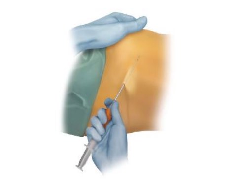 Hogyan zajlik a LIPOGEMS beavatkozás?