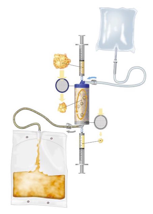 Hogyan zajlik a LIPOGEMS beavatkozás?