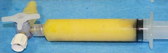 Hogyan zajlik a LIPOGEMS beavatkozás?