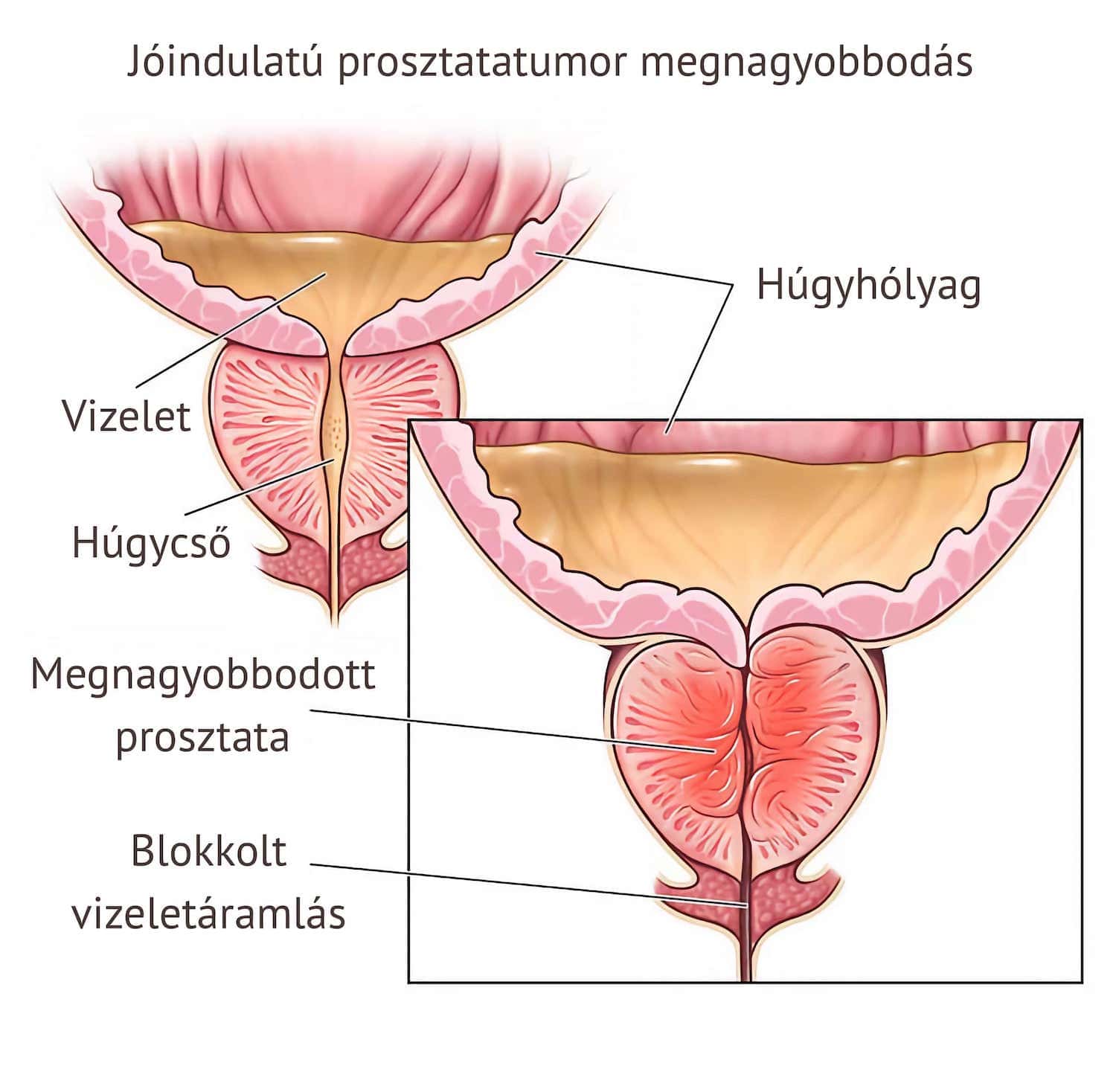 Jóindulatú prosztata megnagyobbodás