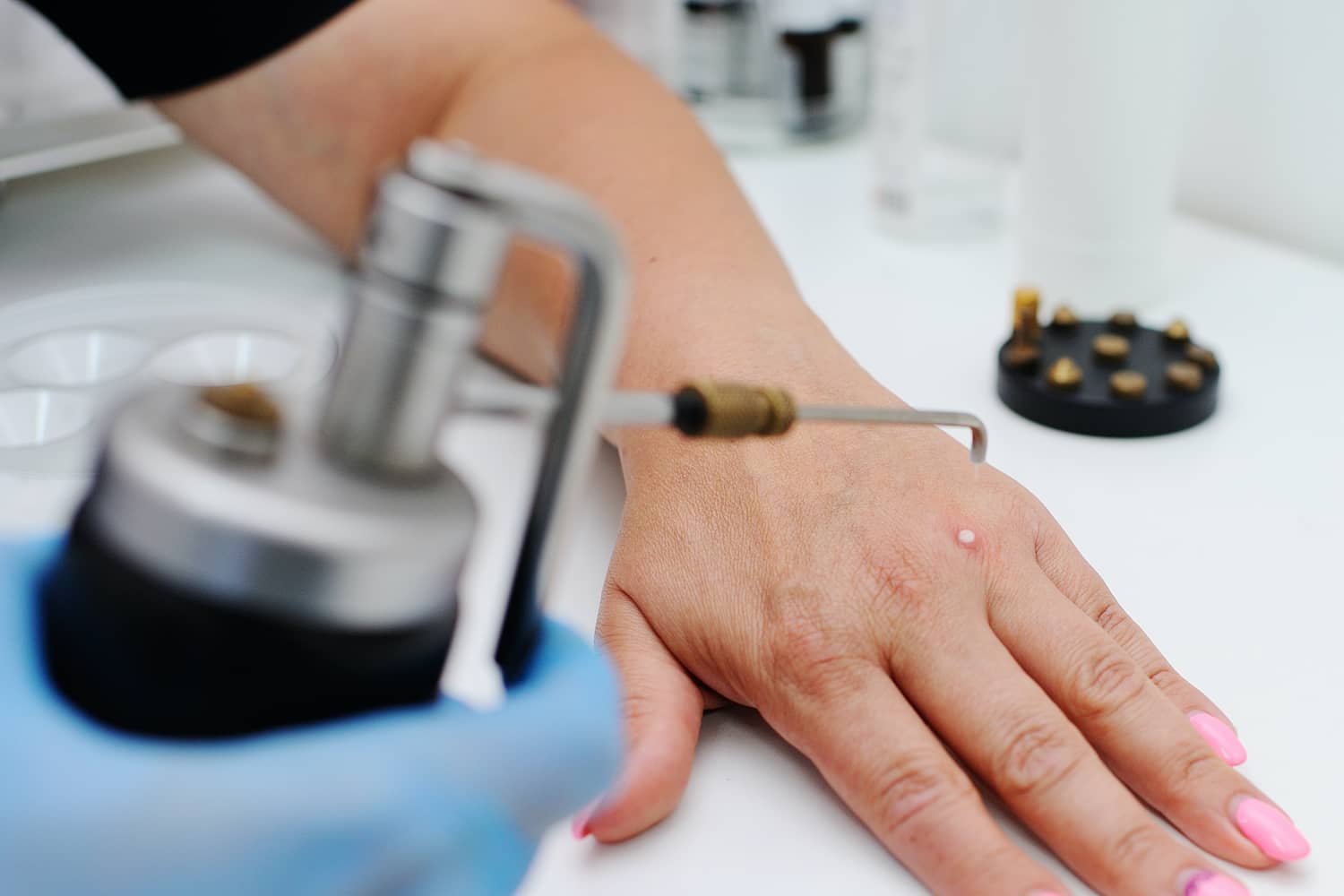 Szemölcs eltávolítás