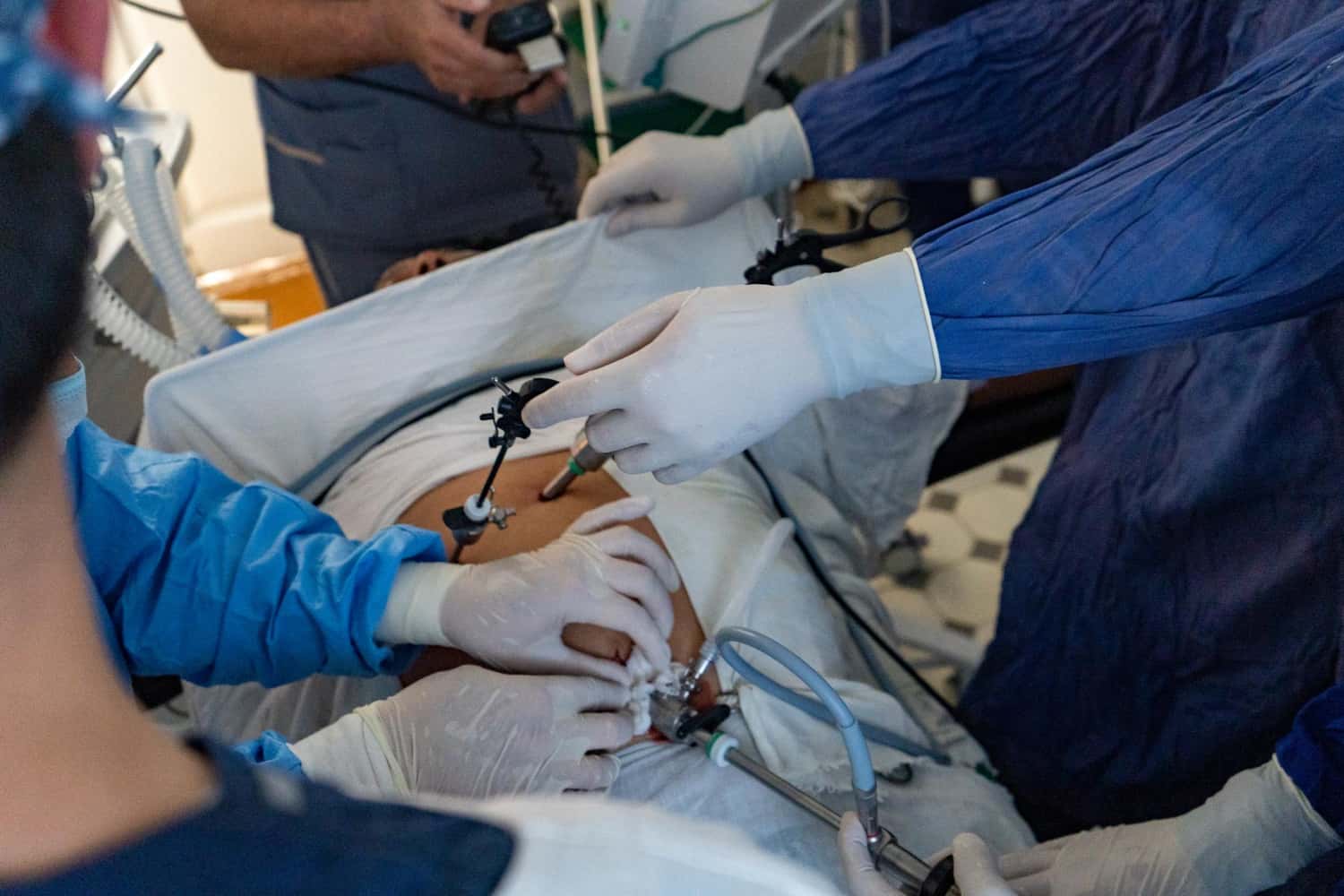 Laparoszkópos epehólyag műtét