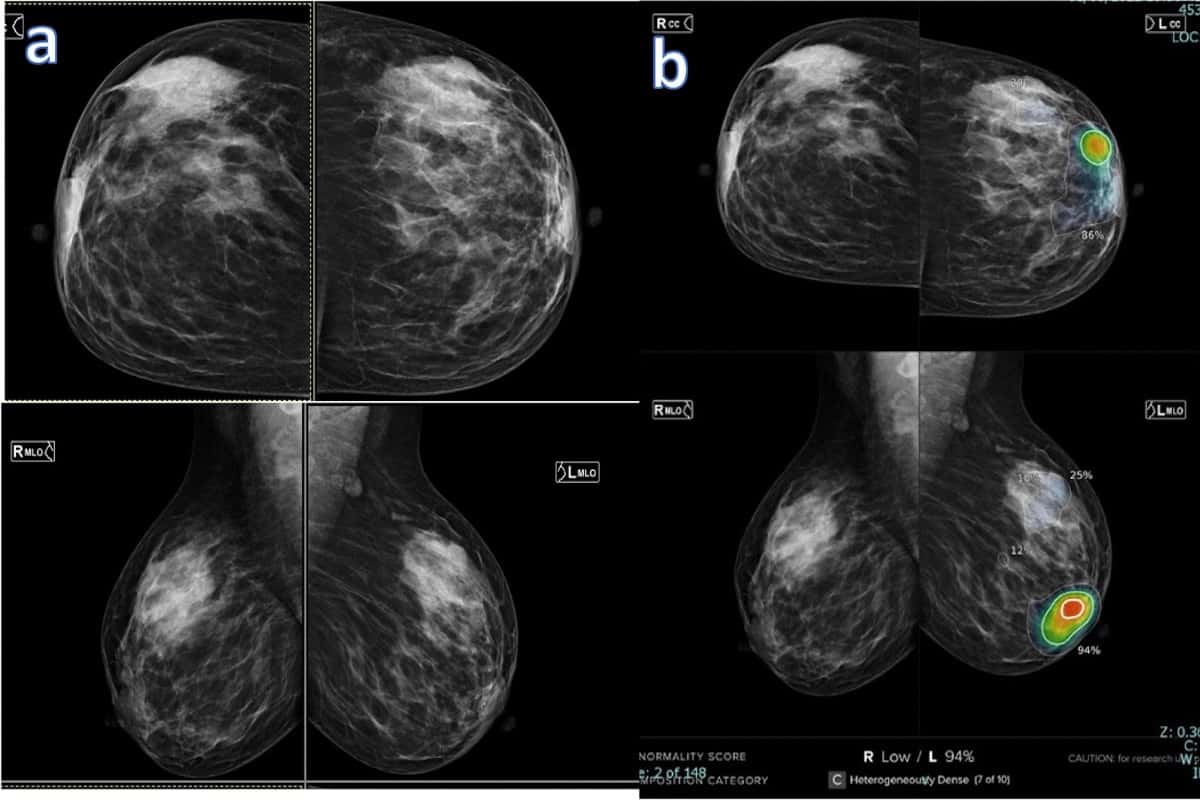 Mammogram